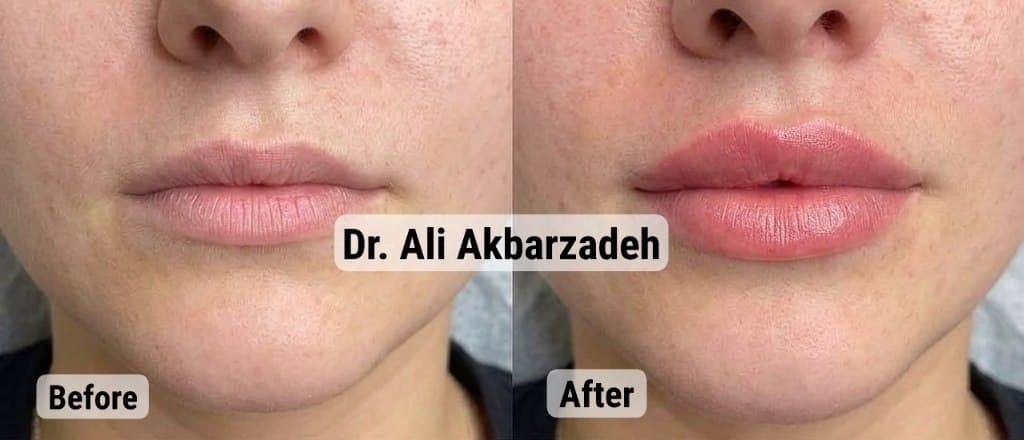 قبل و بعد از فیلر لب، نمای روبه‌رو