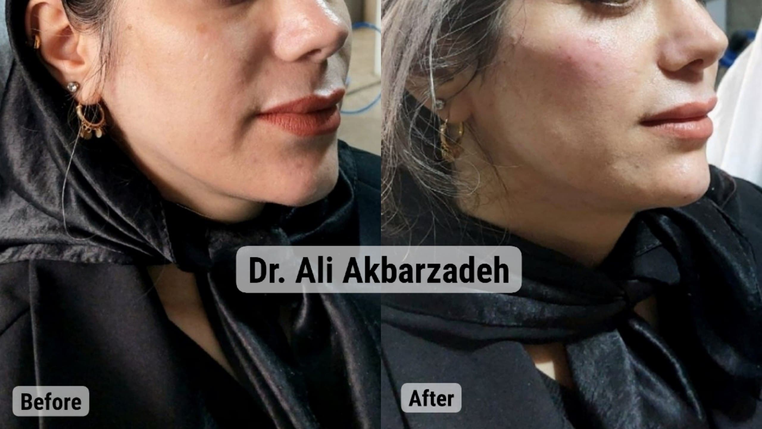 قبل و بعد از فیلر گونه و زاویه‌ی فک