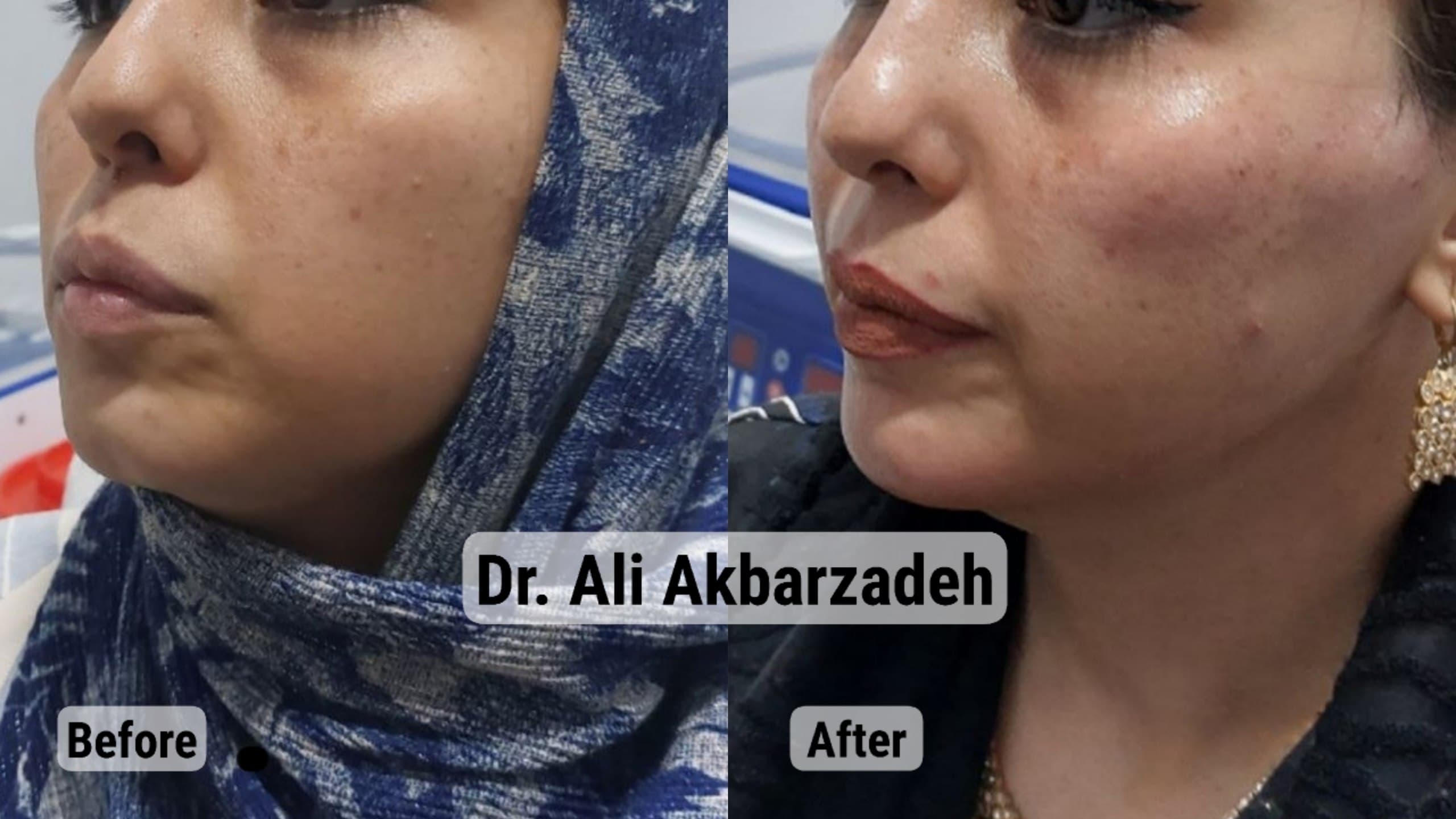 قبل و بعد از حجم‌دهی گونه