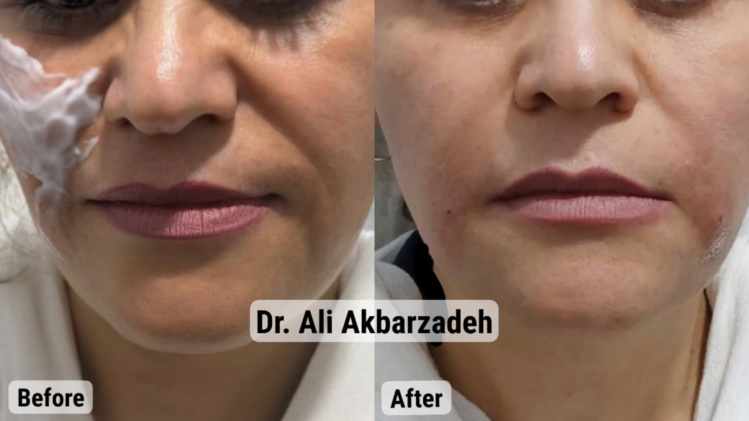 قبل و بعد از اصلاح خط خنده و حجم‌دهی لب